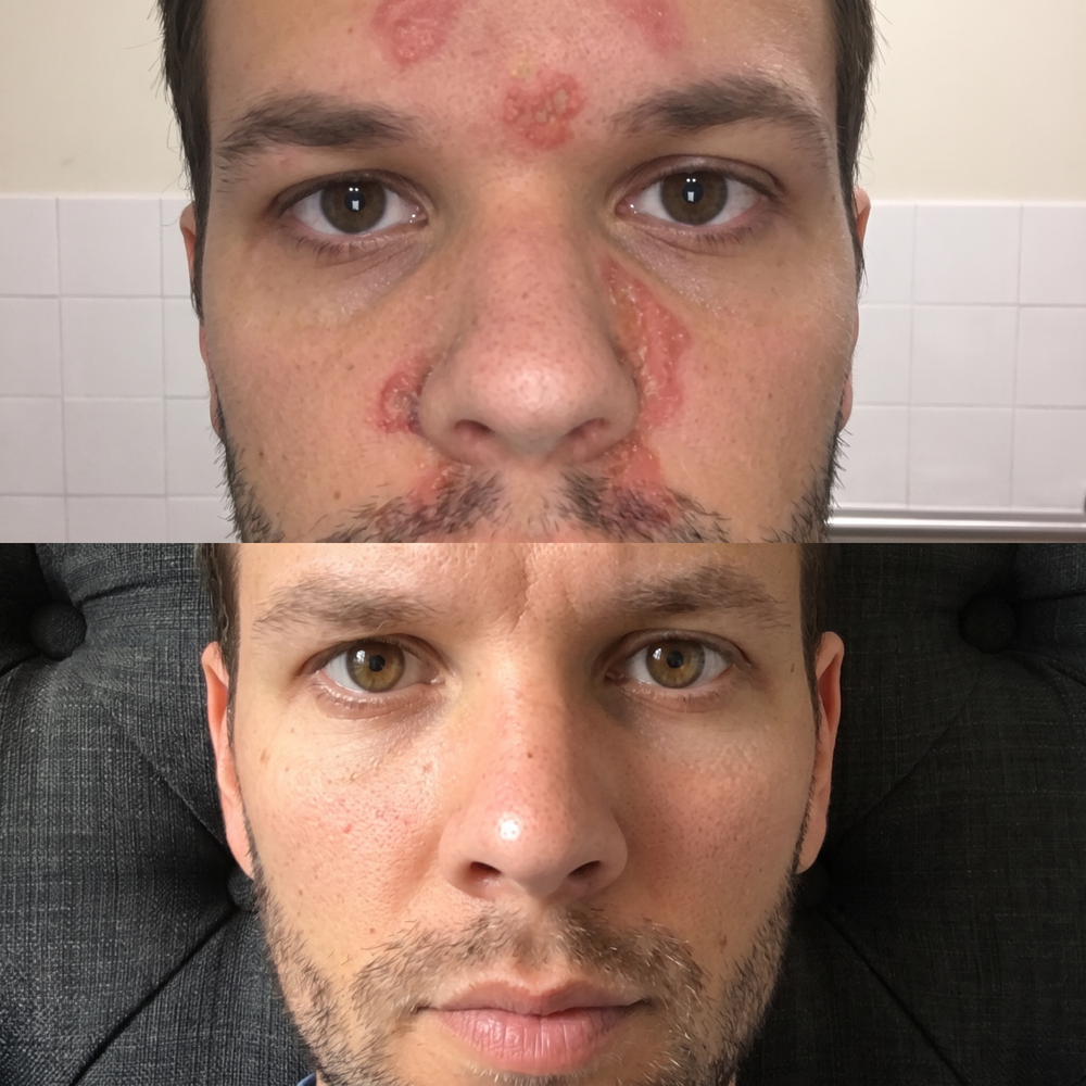 Avant et après, visage d'Adam