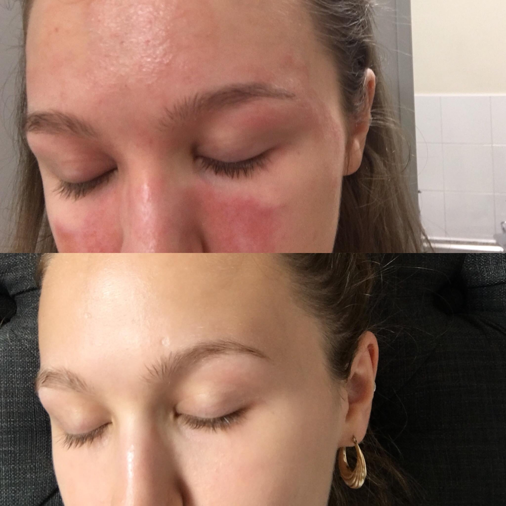 Avant et après, peau de Mira