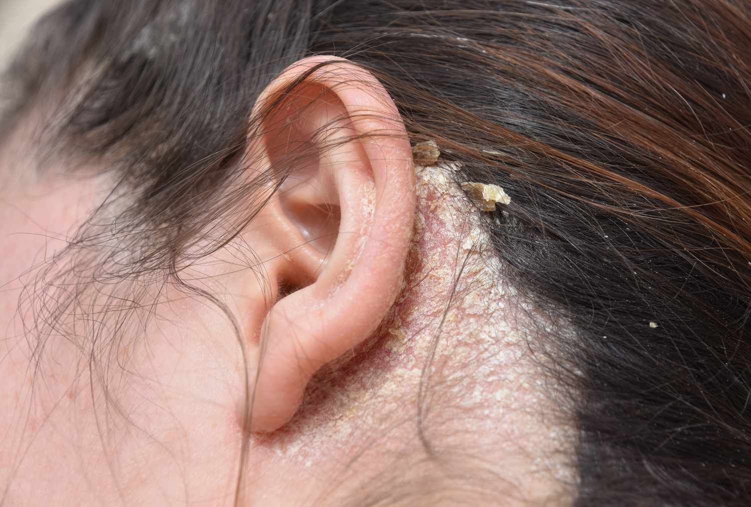 Pellicules et squames derrière l'oreille